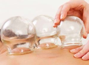 Massage Central Cupping